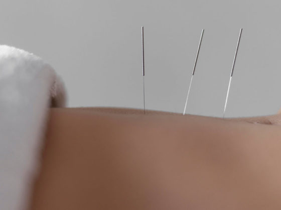 Βελονισμός