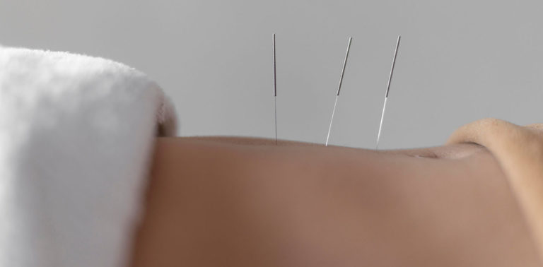 Βελονισμός