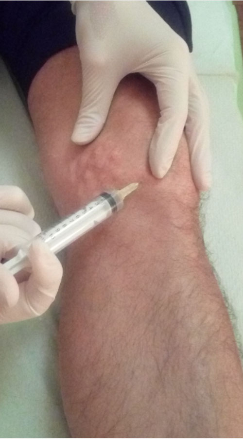 Θεραπευτική Μεσοθεραπεία