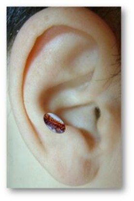 ωτοθεραπεία 