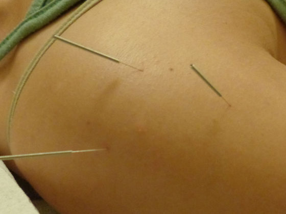 Τι είναι ο βελονισμός;