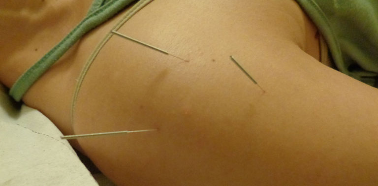 Τι είναι ο βελονισμός;