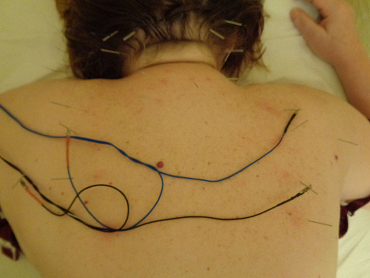 Τι είναι ο βελονισμός;