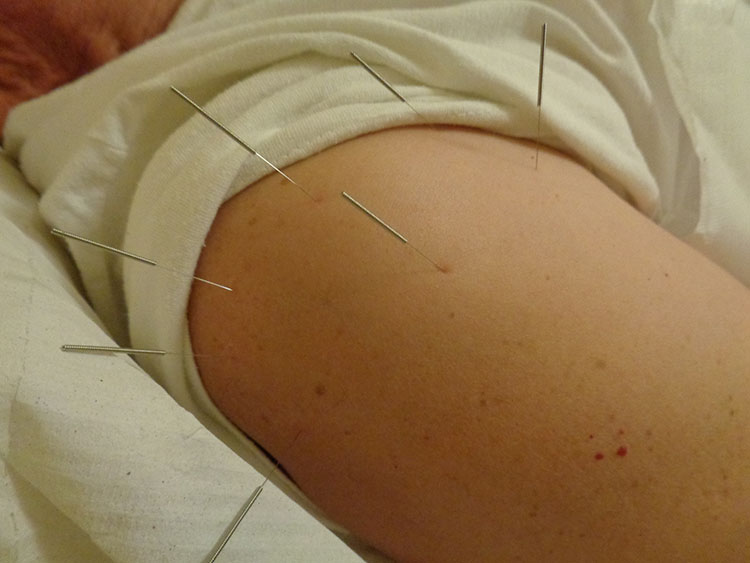 Τι είναι ο βελονισμός;